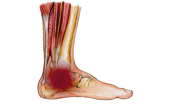 Silipos Active Gel Achilles Heel Sleeve – PPL Biomechanics